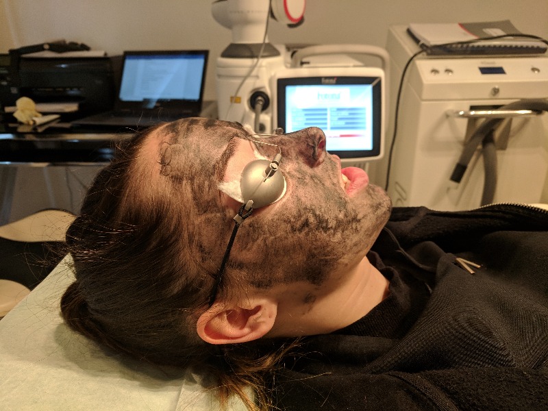 Laser carbon facial peel